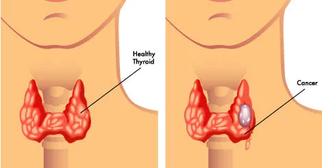 thyroid-cancer-causes-symptoms-p