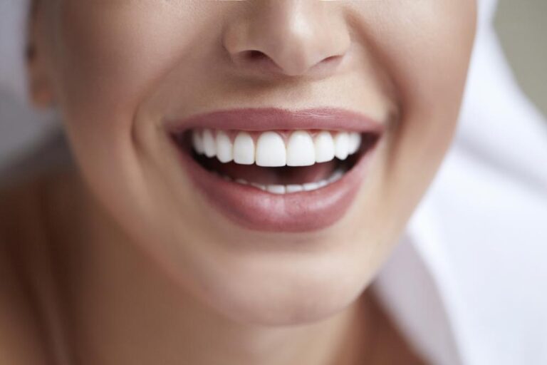 Dental Veneers