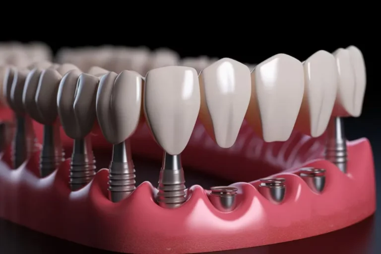 Dental Implants