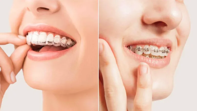 Traditional Braces