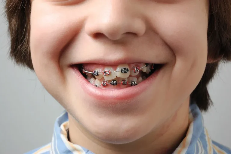 boy-with-braces-closeup